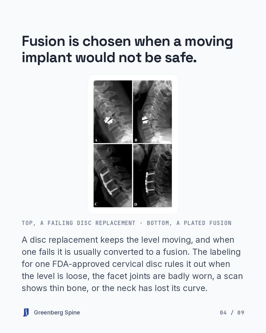 A four-panel published figure of side-view neck X-rays. The top two panels show a cervical disc replacement with a black arrow marking the implant that is failing. The bottom two panels show a plated fusion, with a metal plate and screws across the disc spaces. A caption labels the top row as a failing disc replacement and the bottom row as a plated fusion. The text explains that a disc replacement keeps the level moving, that a failed one is usually converted to a fusion, and that the labeling for one FDA-approved cervical disc rules it out when the level is loose, the facet joints are badly worn, a scan shows thin bone, or the neck has lost its curve.