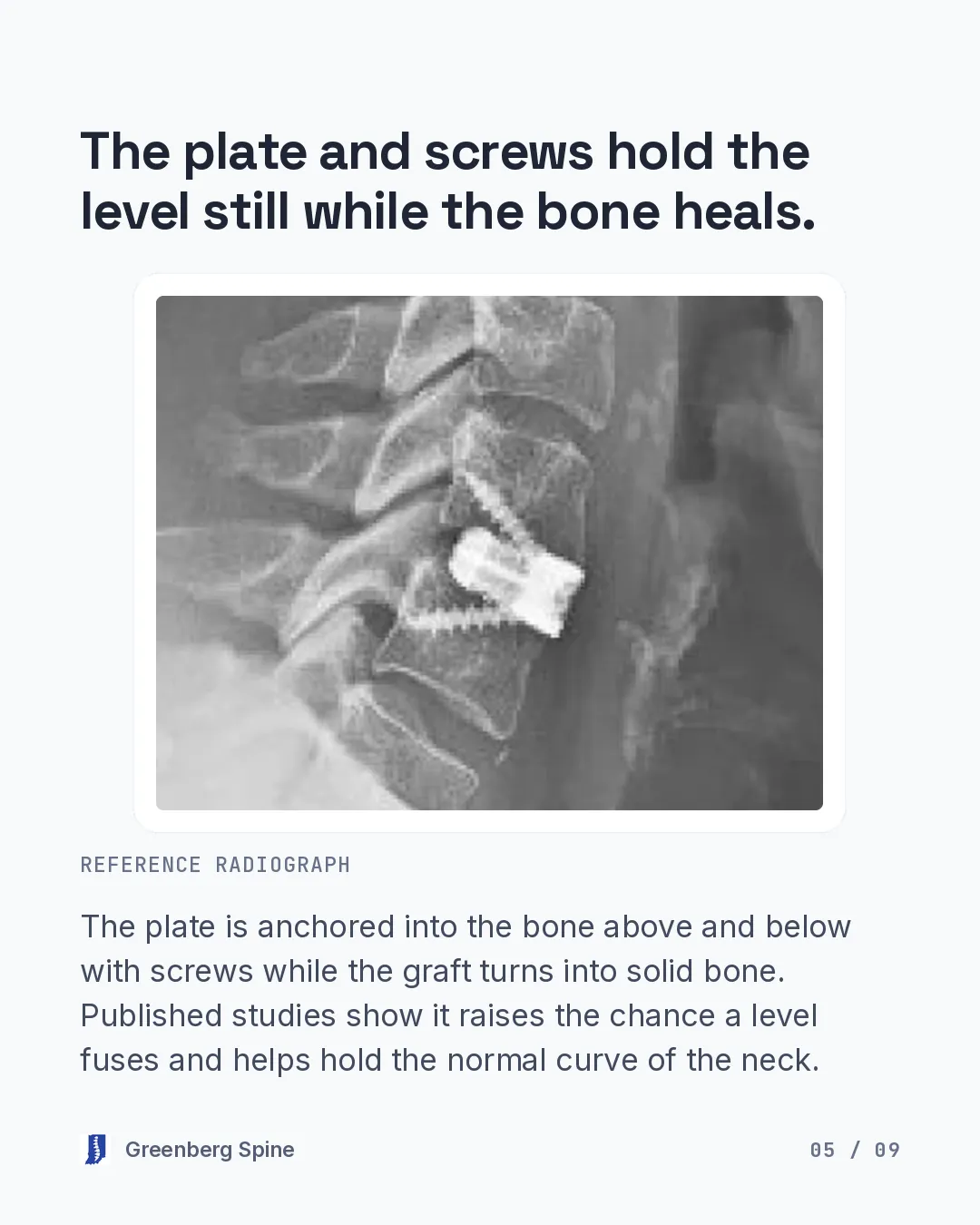 A side-view neck X-ray shows a short metal plate with two screws across one disc space. The text explains that the plate is anchored into the bone above and below with screws while the graft turns into solid bone, and that published studies show it raises the chance a level fuses and helps hold the normal curve of the neck.