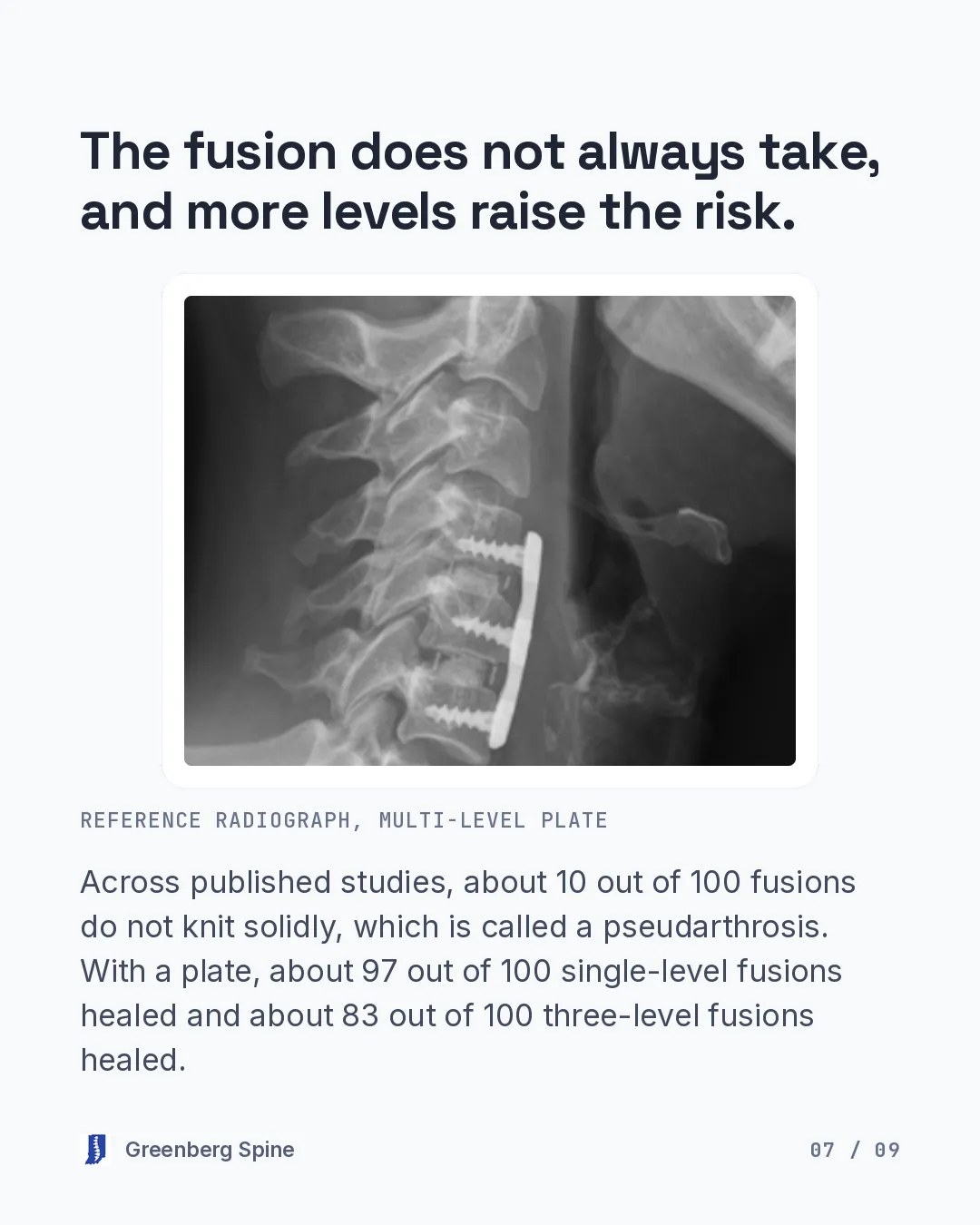 A side-view neck X-ray shows a long metal plate anchored with screws across more than one disc space in the lower neck. The text notes that across published studies about 10 out of 100 fusions do not knit solidly, which is called a pseudarthrosis, and that with a plate about 97 out of 100 single-level fusions healed and about 83 out of 100 three-level fusions healed.