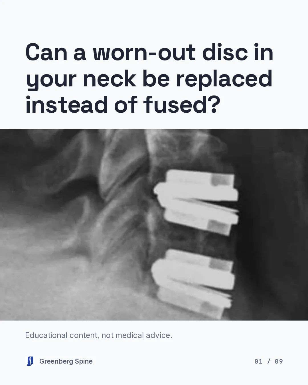 Carousel cover. The headline asks whether a worn-out disc in your neck can be replaced instead of fused. Beneath it, a full-width band from a side-view neck X-ray shows two metal cervical disc replacement implants stacked at neighbouring levels, with a vertebral body above and below them.