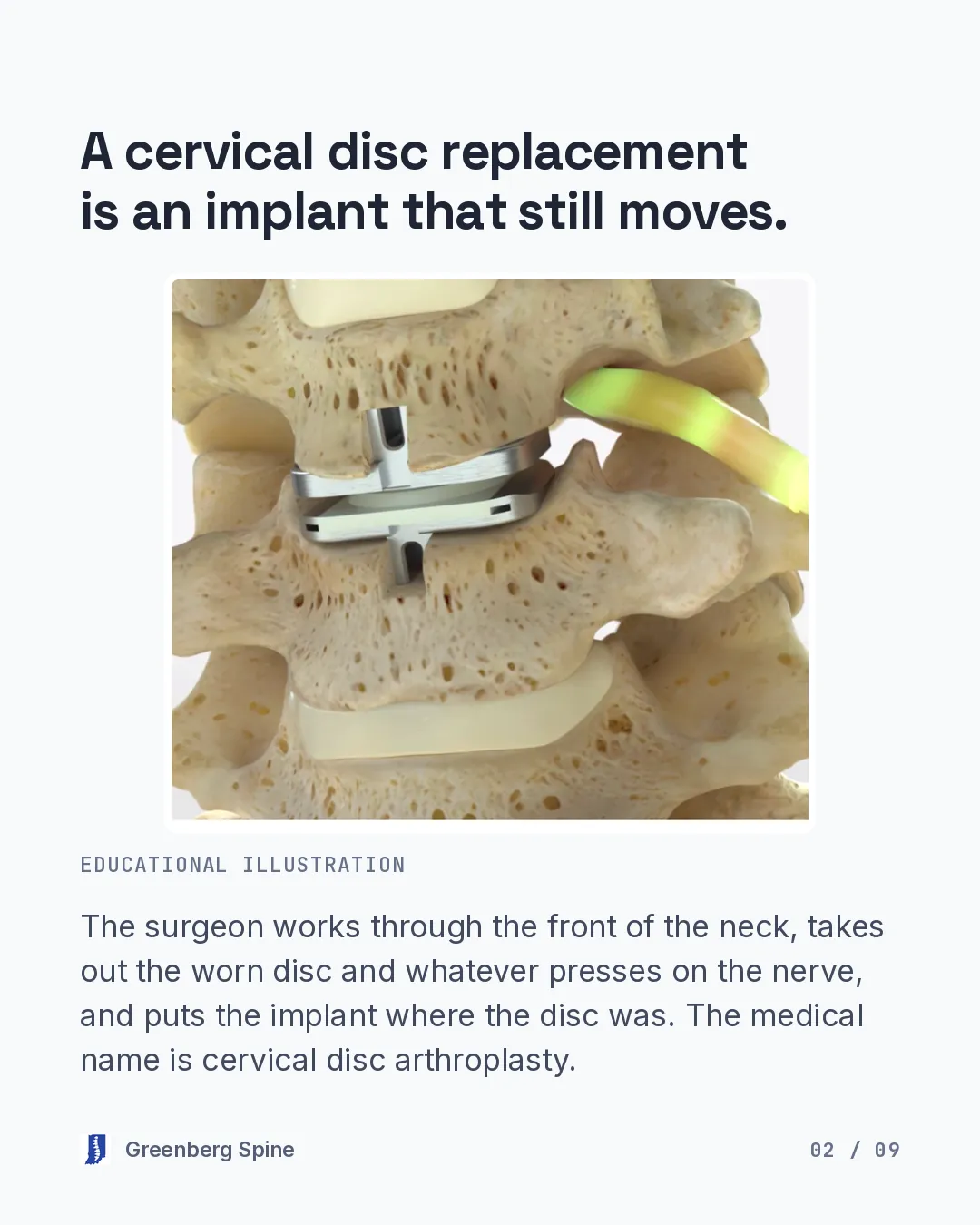 A three-dimensional educational render of the spine cut open shows a disc replacement implant seated between two vertebrae, with the exiting nerve root highlighted in yellow just above and to the side of the implant and normal discs at the levels above and below. The text explains that the surgeon works through the front of the neck, removes the worn disc and whatever presses on the nerve, and puts the implant where the disc was, and that the medical name is cervical disc arthroplasty.