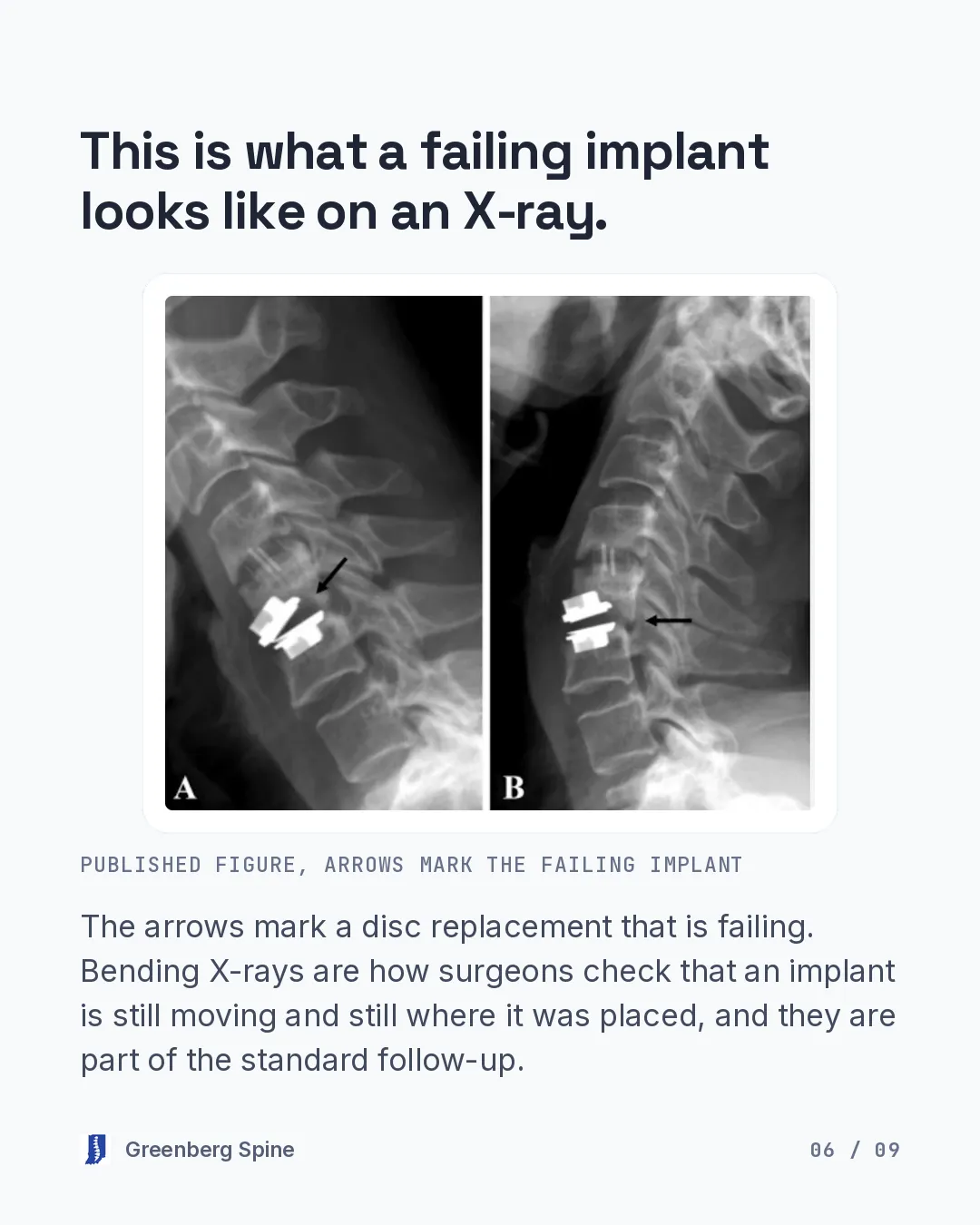 Two side-by-side lateral X-rays from a published figure, labelled A and B, show the same cervical disc replacement with the neck in two different positions, and a black arrow in each panel points to the implant that is failing. The text explains that bending X-rays are how surgeons check that an implant is still moving and still where it was placed, and that they are part of the standard follow-up.