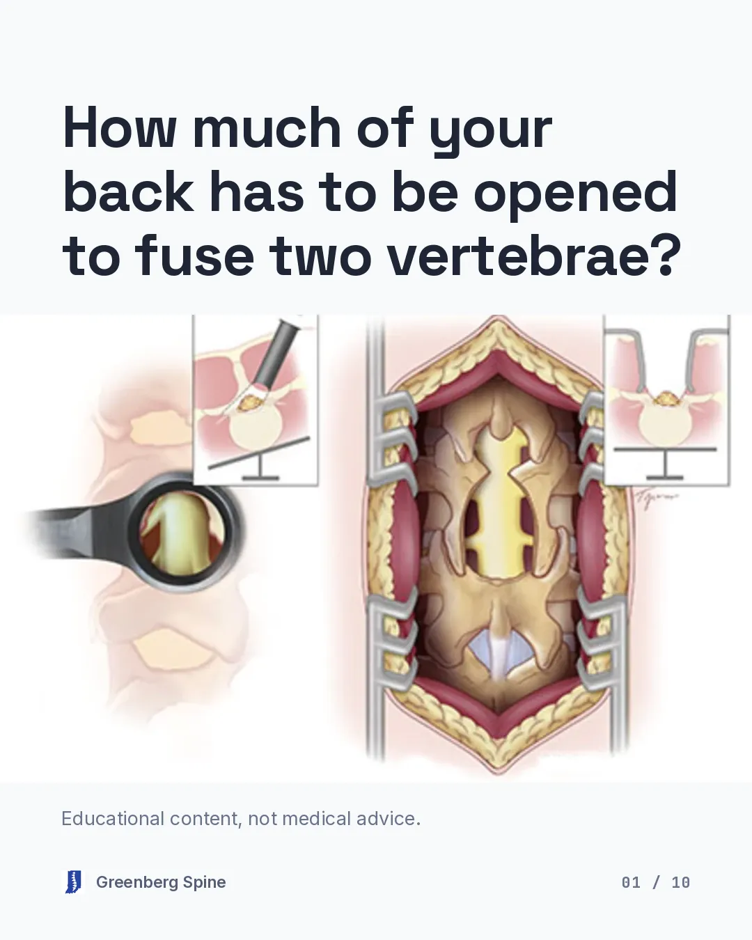 Carousel cover. The headline asks how much of your back has to be opened to fuse two vertebrae. Beneath it, a full-width band from a medical illustration shows a dark tubular retractor docked on the back of the lower spine, with the surgeon's view down the round tube onto the pale bone of the lamina and facet joint.