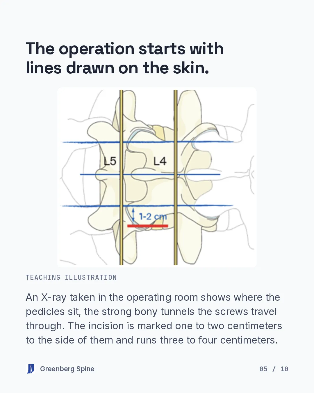 Anatomy slide. A line drawing of the lumbar spine seen from the back, with L4 and L5 labeled, long blue lines marking where the pedicles sit, and guidewires drawn in. The text explains that an X-ray taken in the operating room shows where the pedicles are, the strong bony tunnels the screws travel through, and that the incision is marked one to two centimeters to the side of them and runs three to four centimeters.
