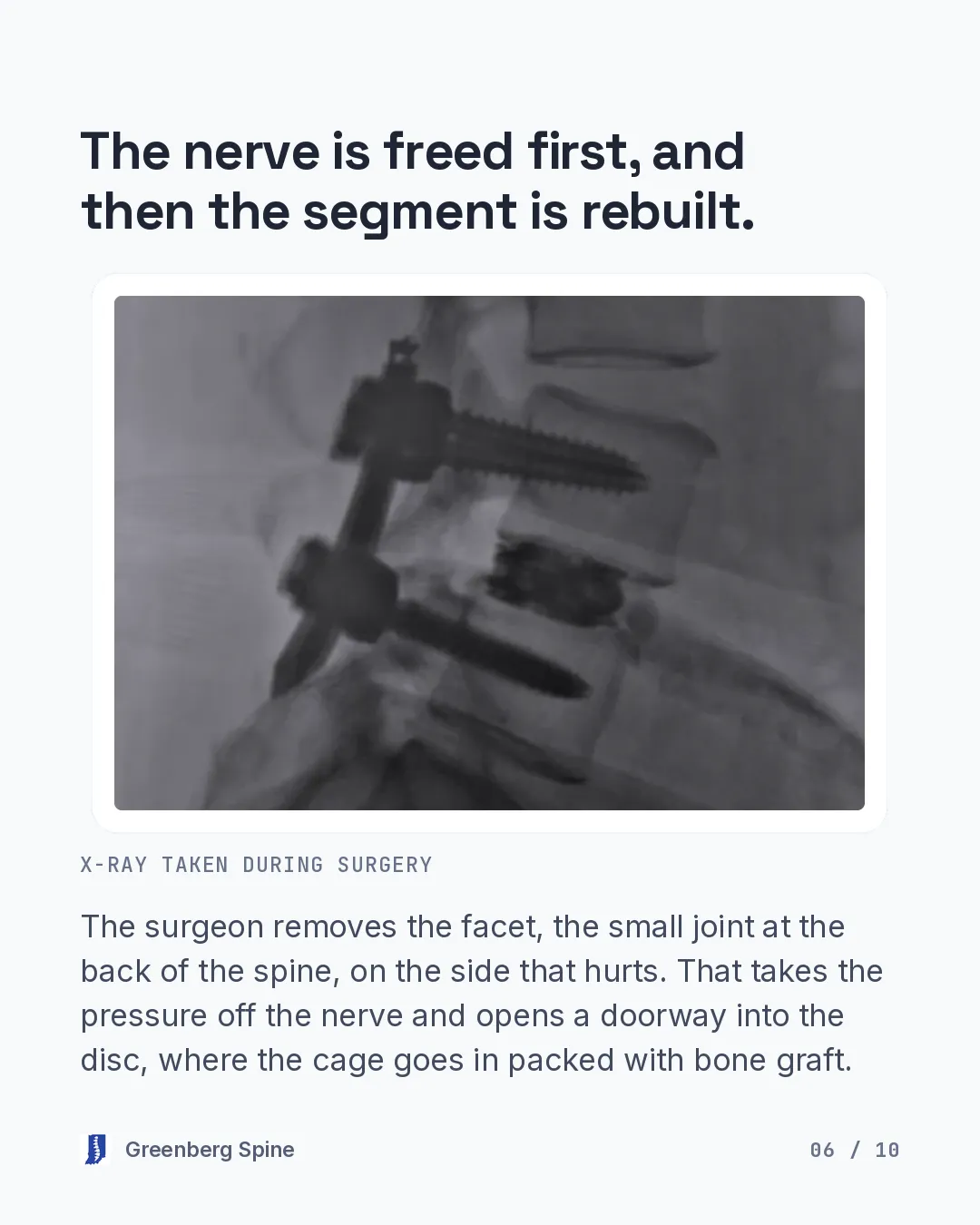 Image slide. A side-view X-ray taken during surgery shows two pedicle screws joined by a rod and a cage sitting in the disc space between the vertebrae. The text explains that the surgeon removes the facet, the small joint at the back of the spine, on the side that hurts, which takes pressure off the nerve and opens a doorway into the disc where the cage goes in packed with bone graft.
