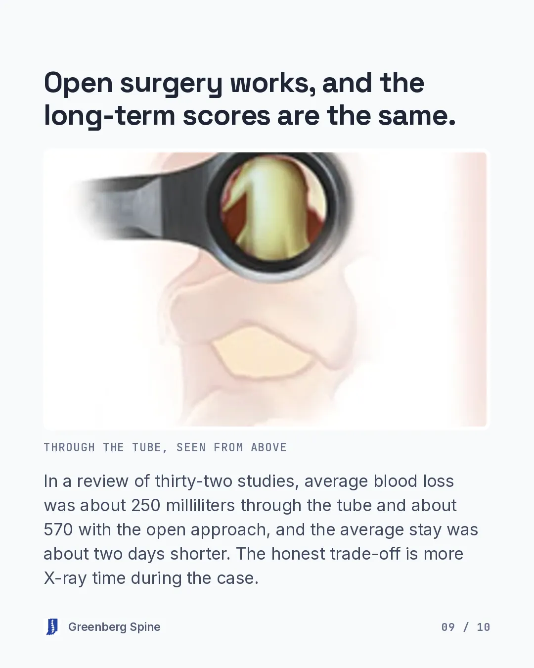 Image slide comparing the two approaches. On the left, a tubular retractor is docked on the spine with the view down the tube. On the right, a conventional open midline exposure is held apart by retractor blades, showing muscle and the exposed laminae and facets. A caption labels the left panel as through a tube and the right panel as open exposure. The text notes that open surgery works and the long-term scores are the same, that in a review of thirty-two studies average blood loss was about 250 milliliters through the tube and about 570 with the open approach, that the average stay was about two days shorter, and that the honest trade-off is more X-ray time during the case.